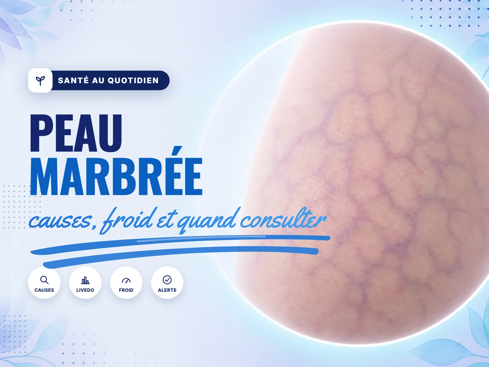 Peau marbrée (livedo) sur une jambe, motif réticulé violacé